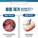 용종 대장용종 대장용종 원인 대장용종 종류 대장 용종 절제술 대장 용종 제거 이미지