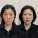 일산바로한의원 | 일산안면비대칭 교정, 내돈내산 일산한의원 후기