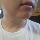 (주)티젤바이오 | 에셀라이트 시카 바이오 스팟 컨트롤 젤 특허유산균으로 피부관리