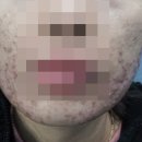 더리터만성점 | 안산지루성피부염 한방피부과(진료과목) 어떻게 치료 시작할까요
