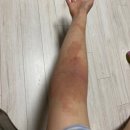 [공지] 지긋지긋했던 성인아토피 내돈내산 관리 5년차 후기