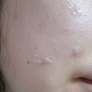 미모약국 | 약국 vs 다이소 여드름 연고 비교 추천