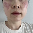 웰피부과 | 익산 웰피부과 쥐젖 잡티 편사 기타 등등 제거 1탄