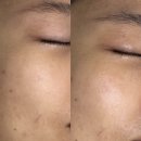 영통 피부관리 [몰리뷰티] 주름 수분 탄력 전후비교 예비신부 후기