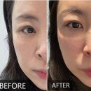 윤&킴 | 압구정 피부과 킴카다시안 줄기세포 주사 mct 3주차 후기