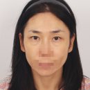 루아크성형외과의원 | 루아크성형외과 눈밑지방재배치 2주차 후기