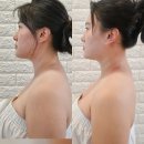호매실 거북목 관리 추천 피부이야기 후기 비포 에프터