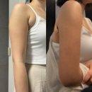 작은팔 | 부유방 지방흡입 팔 지방흡입 후 통증 붓기 일상생활 등 지흡후기 총정리