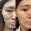 멍스타일 | 강남역성형외과 쥬베룩스킨 4cc눈밑 후기 &amp; 나비존 모공 효과 멍자국은,,