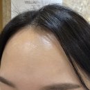 천안 신부동 한의원 오래된 이마 패인흉터치료 새살침 2회차 후기
