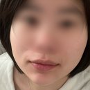 대구 피부과 점빼기 비용, 내돈내산 후기(점제거 후 술,화장,관리)