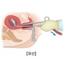 계류유산[稽留流産] 자궁내 임신종결 이미지