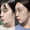 [공지] 명동피부과 슈링크유니버스 리프팅 미친효과 이중턱 + 심부볼 리얼 후기