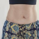 배꼽 | 신사역성형외과 복부미니리프팅 실리프팅 일자배꼽 후기