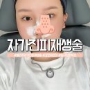 멍쥬 | 압구정로데오 피부과 셀리쥬 자가진피재생술 코모공 리얼 후기