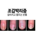 손톱 발톱 들틈 조갑박리증 원인 대처법 이미지