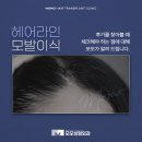 헤어라인모발이식후기 및 찾아볼 때 체크해야 하는 점