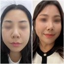 삼일한방사우나 | 리쥬란 스킨부스터 효과 (2차) 솔직후기 (힐러 엠보싱, 주기)