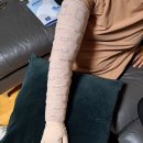 림프 부종 치료를 위한 모비덤 압박 스타킹 착용 후기