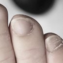 대구한포진 연고로 낫지 않는다면 한의원 치료가 답일까요
