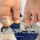 당산네일 후기 영등포 발톱무좀 · 발각질제거 남성관리 가능한 네일몽 레푸스 당산점
