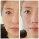 예쁜 얼굴 만들기 | [공지] 부산 윤곽관리 후기｜볼 중앙 꺼짐 보완으로 더 예쁜 작은얼굴라인 만들기