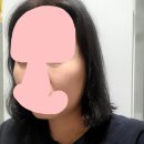 맑고고운시그니처의원 | 우리 엄마 흑자치료기 -1 / 리팟레이저로 거의 10년 묵은 흑자 없애버렸다 ( 인천 동춘동 )