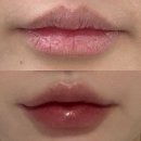 신사역 5번출구 앞 횡단보도 | 신사역 피부과 입술필러 받은 일주일 내돈내산 솔직 효과 후기 통증 당일 붓기