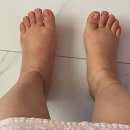 제왕절개 입원기간 후기