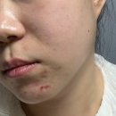 멍# | :: 명동 피부과 추천 :: 리쥬란 효과 7일차 엠보,멍 솔직후기