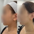 한영대구메디칼(주) | 대구 대명동 웨딩 피부관리 셀룩스프로 리프팅 후기 <아미뷰티센터>