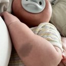 👶 생후 2개월 아기 이소성 몽고반점 레이저 치료 시작! 비용·통증·치료 횟수 후기