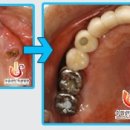 수플란트 이미지