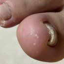 레푸스 망우점 | 레푸스 망우점 : 무좀 내성발톱 내돈내산 발톱관리 솔직후기