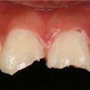 치아파절 원인 및 치료, 보험 (앞니 레진 어금니 크라운 깨짐) 이미지