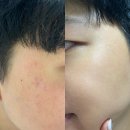 진진약국 | 케이옥시덤 OP 멍크림, 4일 만에 남편 홍조·자국 사라진 리얼 후기