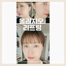 2020-600 | 대구동성로 피부과 올리지오 리프팅 600샷 후기