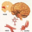 '뇌졸중' 징후 4가지...뇌졸증 제대로 알자 이미지