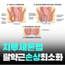 치루개 | 치루 세톤법 수술 후기보다 중요한 관리법