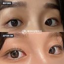 첫눈성형외과의원 네이버블로그