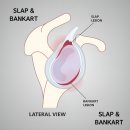 이두메디 | 천안 어깨 재활 SLAP &amp; BANKART