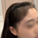 압구정길약국 | 서울 압구정 여성 헤어라인 비절개 모발이식(2,300모) 상담 &amp; 수술당일 후기