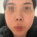 부성약국 | 약국좁쌀여드름연고 에크논 가격 후기