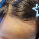 시흥드림항유외과의원 | 25개월 아기 얼굴 '화상' 시흥통원치료 후기