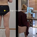 탑라인의원 | 압구정탑라인의원 변상국대표원장 허벅지 지방흡입 후기