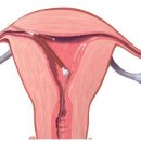 [인테리어의 자궁내막증 제대로 알기]미레나, 과연 안전한가? (1부) "자궁선근증환자의 미레나 시술중 30%가 밀려나와" 이미지