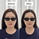 정자역 피부 관리 뷰티 디안느 티리온 아픈정도와 효과 후기