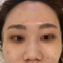 올가드림뷰티 다산도농점 트러블관리 받고 옴 다산동 피부관리 에스테틱