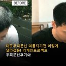 대구두피문신 여름되기전 이렇게 달라졌음! 리게인프로젝트 두피문신후기와 효과