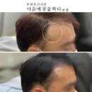 SMP수강잘하는 광주 월계동 SMP수강 마음에점을찍다 광주본점 SMP 두피